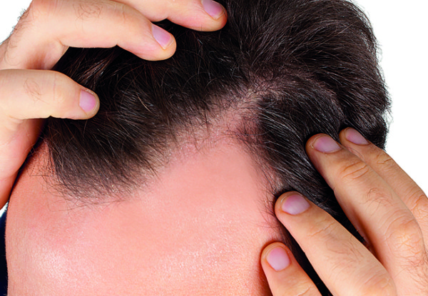 Man controls hair loss