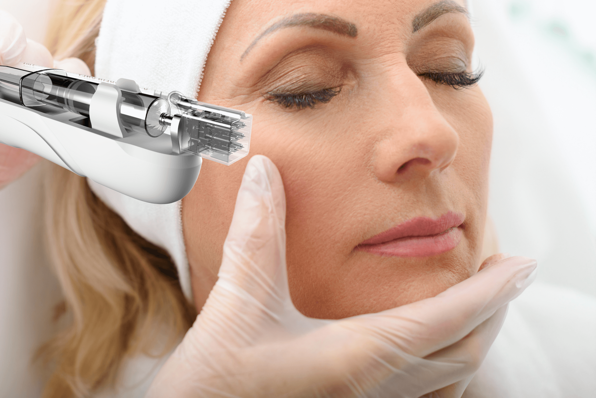 Micro-Needling-Microneedling-Leipzig-Kosmetik Leipzig Microneedling-Vakuum-Plus